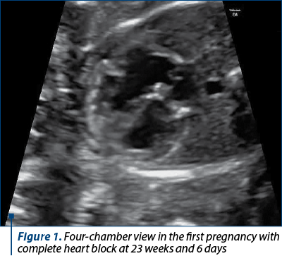 Figure 1. Four-chamber view in the first pregnancy with complete heart block at 23 weeks and 6 days