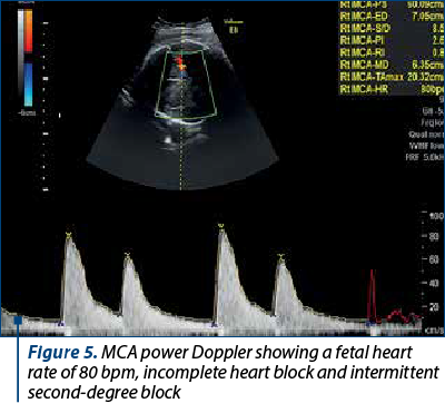 Figure 5. MCA power Doppler showing a fetal heart rate of 80 bpm, incomplete heart block and intermittent second-degree block 