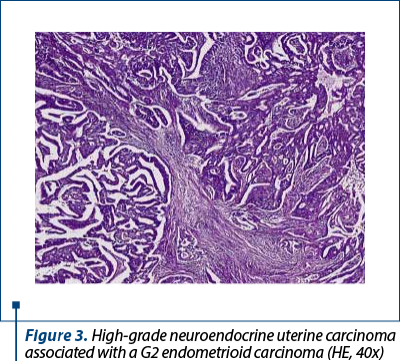 Figure 3. High-grade neuroendocrine uterine carcinoma associated with a G2 endometrioid carcinoma (HE, 40x)