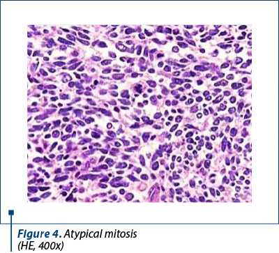 Figure 4. Atypical mitosis  (HE, 400x)