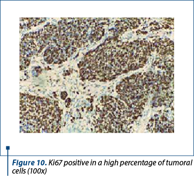 Figure 10. Ki67 positive in a high percentage of tumoral cells (100x)
