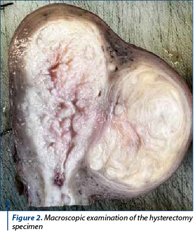 Figure 2. Macroscopic examination of the hysterectomy specimen