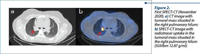 Figure 2.  First SPECT-CT (November 2020). a) CT image with tumoral mass situated in the right pulmonary hilum; b) SPECT-CT image with radiotracer uptake in the tumoral mass situated in the right pulmonary hilum (SUVlbm 12.87 g/ml) 