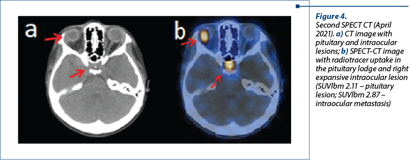 Figure 4.  Second SPECT CT (April 2021). a) CT image with pituitary and intraocular lesions; b) SPECT-CT image with radiotracer uptake in the pituitary lodge and right expansive intraocular lesion (SUVlbm 2.11 – pituitary lesion; SUVlbm 2.87 – intraocular metastasis)