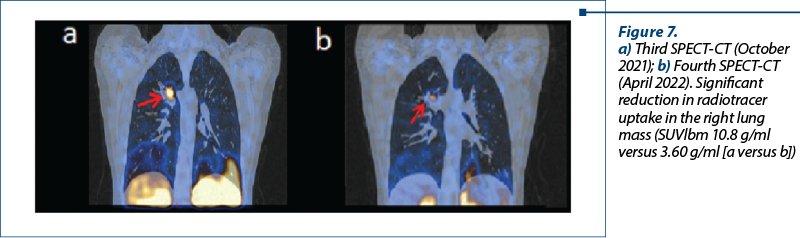 Figure 7.  a) Third SPECT-CT (October 2021); b) Fourth SPECT-CT (April 2022). Significant reduction in radiotracer uptake in the right lung mass (SUVlbm 10.8 g/ml versus 3.60 g/ml [a versus b])