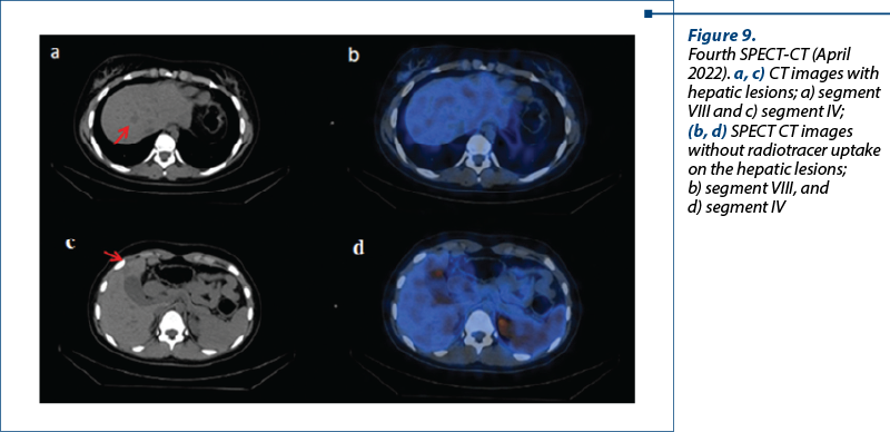 Figure 9.  Fourth SPECT-CT (April 2022). a, c) CT images with hepatic lesions; a) segment VIII and c) segment IV;  (b, d) SPECT CT images without radiotracer uptake on the hepatic lesions;  b) segment VIII, and  d) segment IV