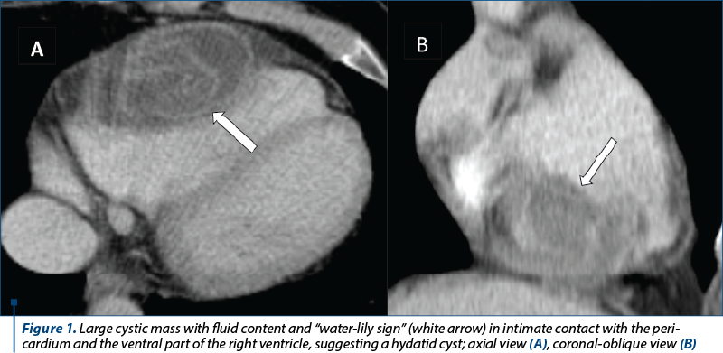 Figure 1. Large cystic mass with fluid content and “water-lily sign” (white arrow) in intimate contact with the peri­cardium and the ventral part of the right ventricle, suggesting a hydatid cyst; axial view (A), coronal-oblique view (B)