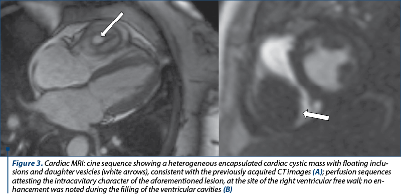 Figure 3. Cardiac MRI: cine sequence showing a heterogeneous encapsulated cardiac cystic mass with floating in­clu­sions and daughter vesicles (white arrows), consistent with the previously acquired CT images (A); perfusion sequences at­tes­ting the intracavitary character of the aforementioned lesion, at the site of the right ventricular free wall; no en­hance­ment was noted during the filling of the ventricular cavities (B)