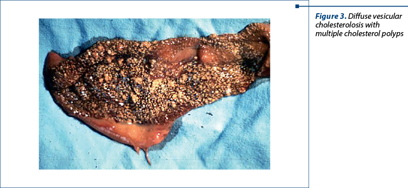 Figure 3. Diffuse vesicular cholesterolosis with multiple cholesterol polyps 