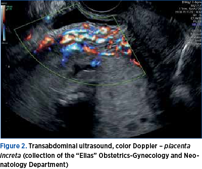 Figure 2. Transabdominal ultrasound, color Doppler – placenta increta (collection of the “Elias” Obstetrics-Gynecology and Neonatology Department)