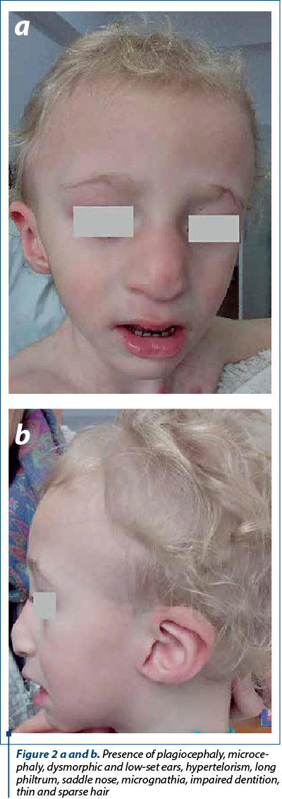 Figure 2 a and b. Presence of plagiocephaly, micro­ce­phaly, dysmorphic and low-set ears, hypertelorism, long philtrum, saddle nose, micrognathia, impaired dentition, thin and sparse hair