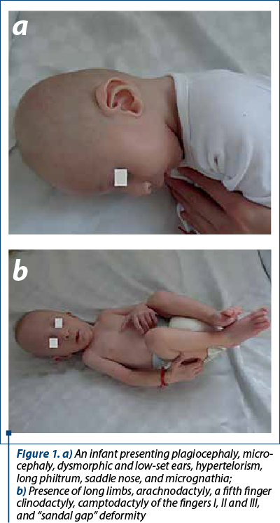 Figure 1. a) An infant presenting plagiocephaly, micro­ce­phaly, dysmorphic and low-set ears, hypertelorism, long philtrum, saddle nose, and micrognathia;  b) Pre­­sence of long limbs, arachnodactyly, a fifth finger cli­no­dactyly, camptodactyly of the fingers I, II and III, and “sandal gap” deformity