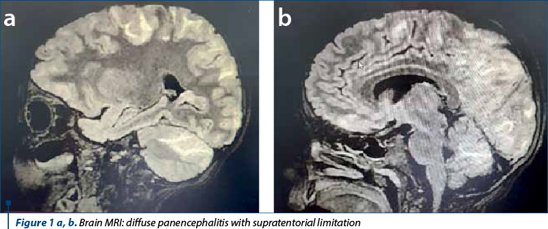 Figure 1 a, b. Brain MRI: diffuse panencephalitis with supratentorial limitation