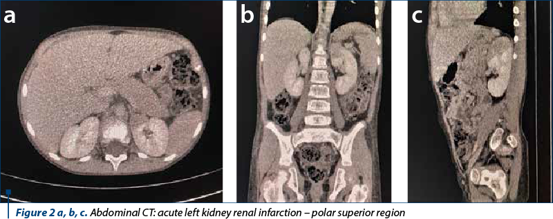 Figure 2 a, b, c. Abdominal CT: acute left kidney renal infarction – polar superior region