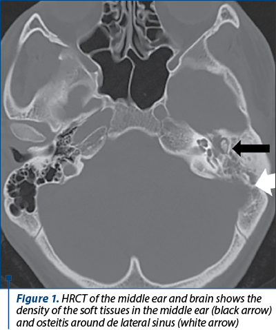 Figure 1. HRCT of the middle ear and brain shows the density of the soft tissues in the middle ear (black arrow) and osteitis around de lateral sinus (white arrow) 