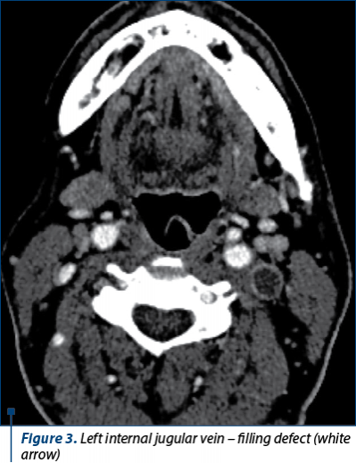 Figure 2. HRCT of the brain shows the “delta sign” on the left lateral sinus (tip of the black arrow)