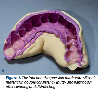 Figure 1. The functional impression made with siliconic material in double consistency (putty and light body) after cleaning and disinfecting