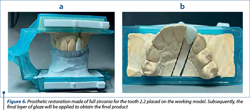Figure 6. Prosthetic restoration made of full zirconia for the tooth 2.2 placed on the working model. Subsequently, the final layer of glaze will be applied to obtain the final product