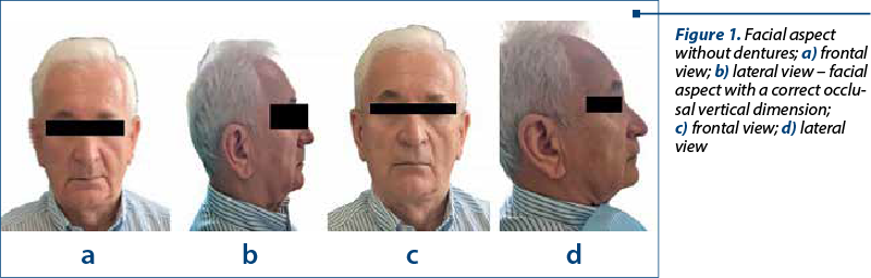 Figure 1. Facial aspect with­out dentures; a) frontal view; b) lateral view – facial aspect with a correct oc­clu­sal vertical dimension;  c) frontal view; d) lateral view