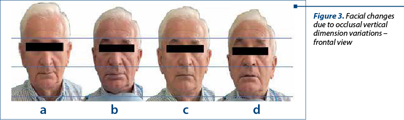 Figure 3. Facial changes due to occlusal vertical dimension variations – frontal view