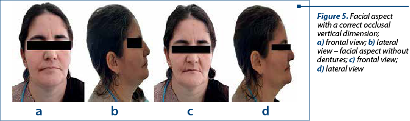 Figure 5. Facial aspect with a correct occlusal vertical dimension;  a) fron­tal view; b) lateral view – facial aspect without den­tures; c) frontal view;  d) la­te­ral view 