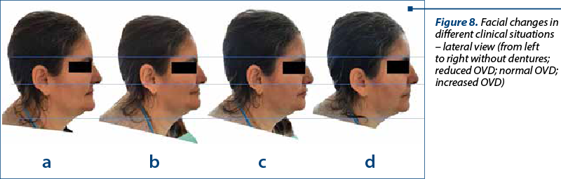 Figure 8. Facial changes in different clinical situations – lateral view (from left to right without dentures; reduced OVD; normal OVD; increased OVD)