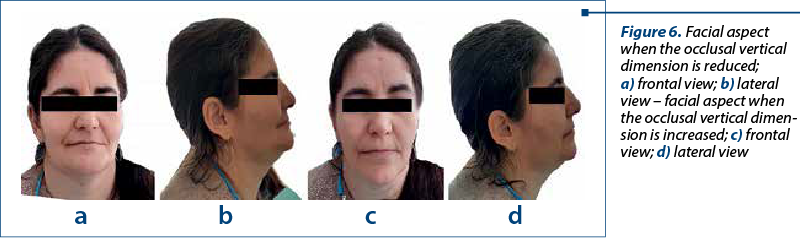 Figure 6. Facial aspect when the occlusal vertical dimension is reduced;  a) frontal view; b) lateral view – facial aspect when the occlusal vertical di­men­sion is increased; c) frontal view; d) lateral view