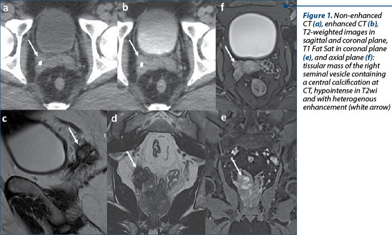 Figure 1. Non-enhanced CT (a), enhanced CT (b), T2-weighted images in sagittal and coronal plane, T1 Fat Sat in coronal plane (e), and axial plane (f): tissular mass of the right seminal vesicle containing a central calcification at CT, hypointense in T2wi and with heterogenous enhancement (white arrow)
