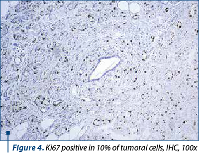 Figure 4. Ki67 positive in 10% of tumoral cells, IHC, 100x