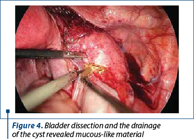 Figure 4. Bladder dissection and the drainage  of the cyst revealed mucous-like material