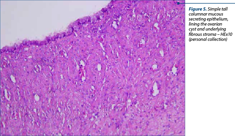 Figure 5. Simple tall columnar mucous secreting epithelium, lining the ovarian cyst and underlying fibrous stroma – HEx10 (personal collection)
