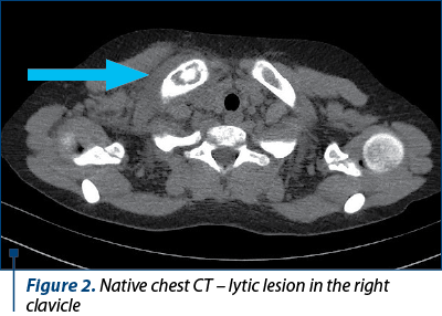 Figure 2. Native chest CT – lytic lesion in the right clavicle