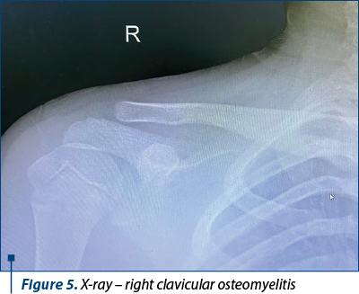 Figure 5. X-ray – right clavicular osteomyelitis