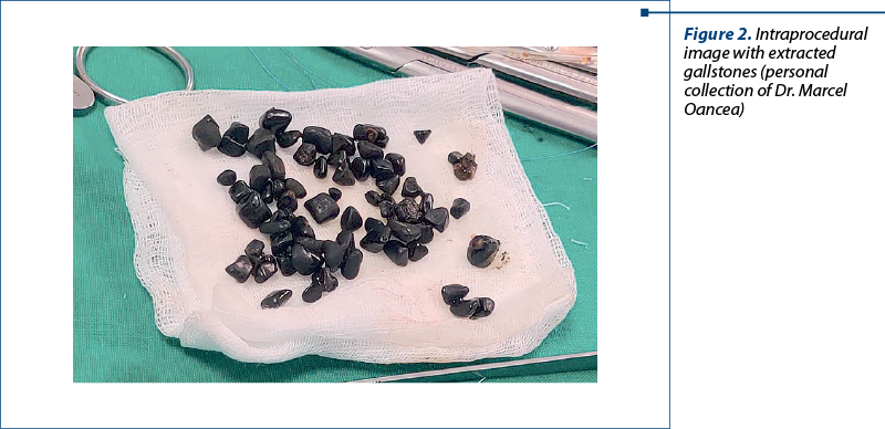 Figure 2. Intraprocedural image with extracted gallstones (personal collection of Dr. Marcel Oancea)