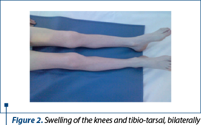 Figure 2. Swelling of the knees and tibio-tarsal, bilaterally