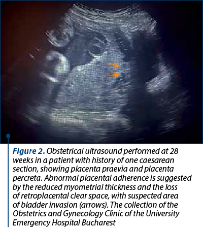 Figure 2. Obstetrical ultrasound performed at 28 weeks in a patient with history of one caesarean section, showing placenta praevia and placenta percreta. Abnormal placental adherence is suggested by the reduced myometrial thickness and the loss of retroplacental clear space, with suspected area of bladder invasion (arrows). The collection of the Obstetrics and Gynecology Clinic of the University Emergency Hospital Bucharest