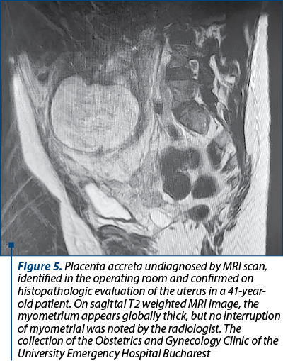 Figure 5. Placenta accreta undiagnosed by MRI scan, identified in the operating room and confirmed on histopathologic evaluation of the uterus in a 41-year-old patient. On sagittal T2 weighted MRI image, the myometrium appears globally thick, but no interruption of myometrial was noted by the radiologist. The collection of the Obstetrics and Gynecology Clinic of the University Emergency Hospital Bucharest
