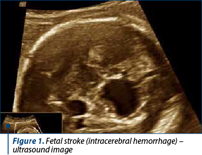Figure 1. Fetal stroke (intracerebral hemorrhage) – ultrasound image