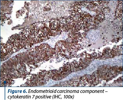 Figure 6. Endometrioid carcinoma component – cytokeratin 7 positive (IHC, 100x)