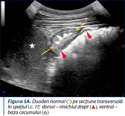 Figura 5A. Duoden normal (↑) pe secţiune transversală în spaţiul i.c. 17;  dorsal – rinichiul drept (☆), ventral – baza cecumului (▲)