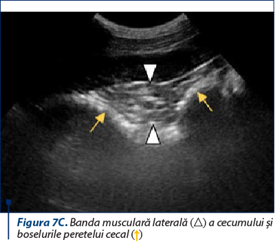 Figura 7C. Banda musculară laterală (△) a cecumului şi boselurile peretelui cecal (↑)