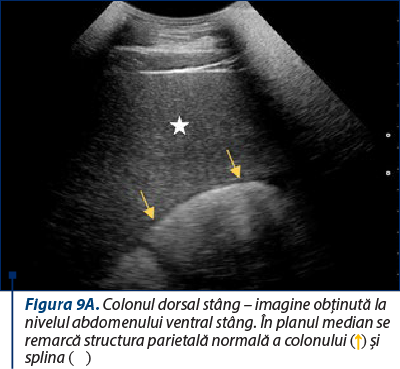Figura 9A. Colonul dorsal stâng – imagine obţinută la nivelul abdomenului ventral stâng. În planul median se remarcă structura parietală normală a colonului (↑) şi splina (☆)