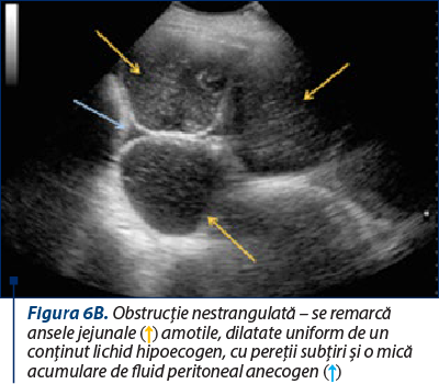 Figura 6B. Obstrucţie nestrangulată – se remarcă ansele jejunale (↑) amotile, dilatate uniform de un conţinut lichid hipoecogen, cu pereţii subţiri şi o mică acumulare de fluid peritoneal anecogen (↑)