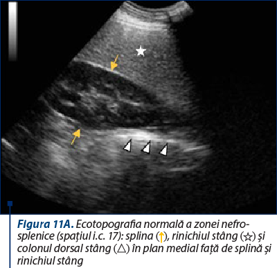Figura 11A. Ecotopografia normală a zonei nefro-splenice (spaţiul i.c. 17): splina (↑), rinichiul stâng (☆) şi colonul dorsal stâng (△) în plan medial faţă de splină şi rinichiul stâng