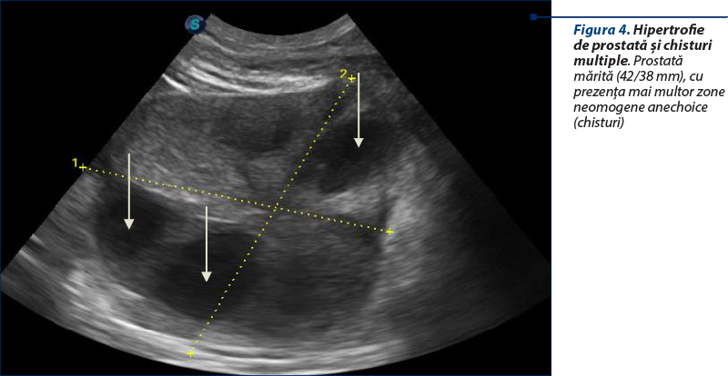 Figura 4. Hipertrofie de prostată şi chisturi multiple. Prostată mărită (42/38 mm), cu prezenţa mai multor zone neomogene anechoice (chisturi)