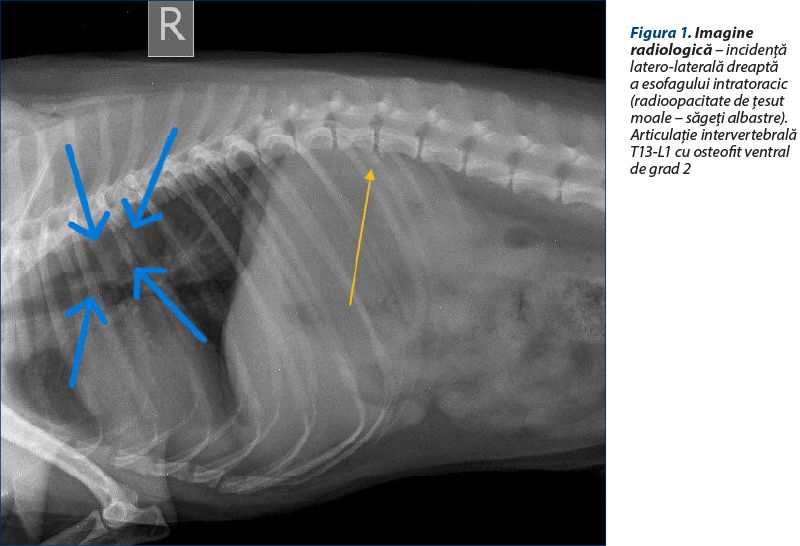Figura 1. Imagine radiologică – incidenţă latero-laterală dreaptă a esofagului intratoracic (radioopacitate de ţesut moale – săgeţi albastre). Articulaţie intervertebrală T13-L1 cu osteofit ventral de grad 2