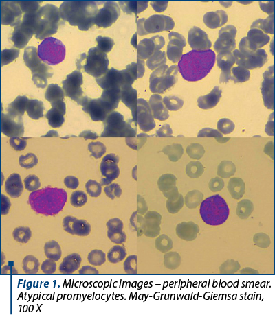 Figure 1. Microscopic images – peripheral blood smear. Atypical promyelocytes. May-Grunwald-Giemsa stain, 100 X