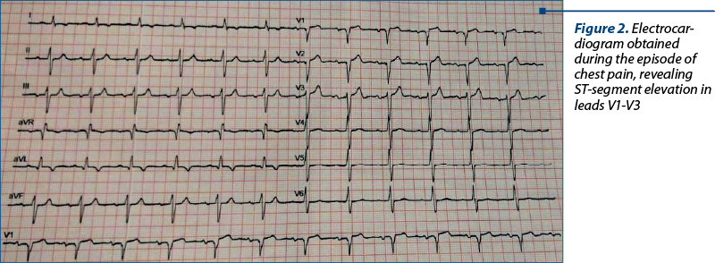 Figure 2. Electro­car­dio­gram obtained during the episode of chest pain, revealing ST-segment elevation in leads V1-V3