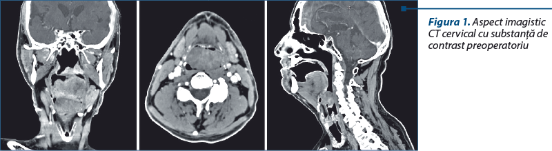 Figura 1. Aspect imagistic CT cervical cu substanţă de contrast preoperatoriu
