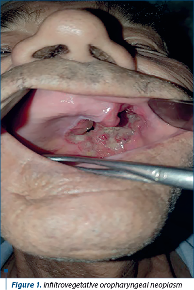 Figure 1. Infiltrovegetative oropharyngeal neoplasm